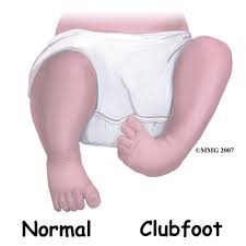 Clubfoot